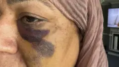 A close up photo of a woman's face. She has a dark bruise under her eye and wears a pale pink headscarf